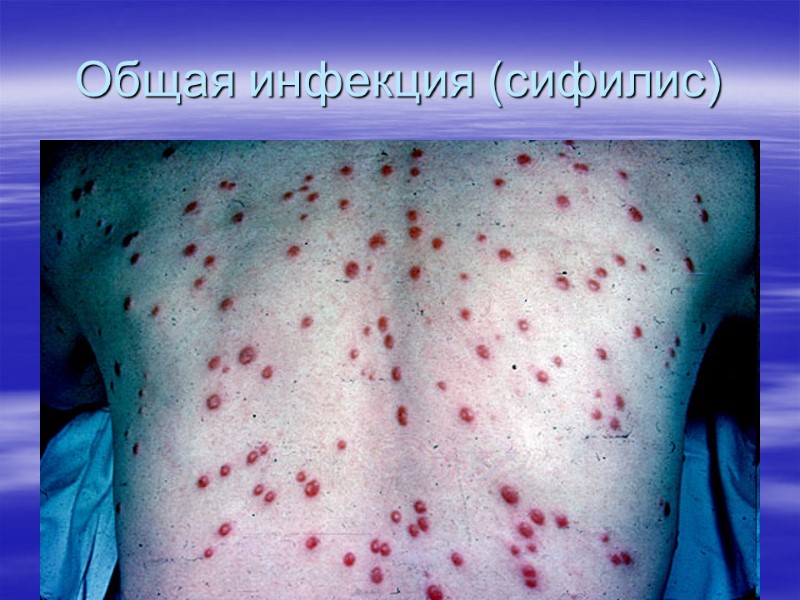 Общая инфекция (сифилис)